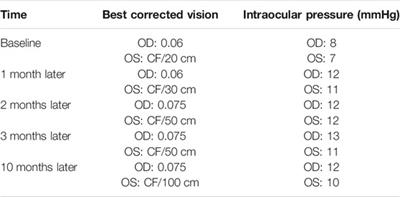 Case Report: A Promising Treatment Strategy for Noninfectious Uveitis